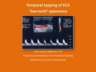 Temporal tapping of ECA
“Saw-tooth” appearance

Small regular deflections (TT)
Frequency corresponds to rate of temporal t...