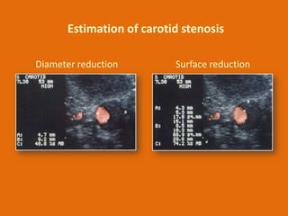 Estimation of carotid stenosis
Diameter reduction

Surface reduction

 