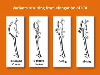 Variants resulting from elongation of ICA

 