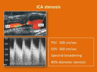 ICA stenosis

PSV 500 cm/sec
EDV 300 cm/sec
Spectral broadening
80% diameter stenosis

 