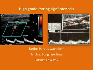 High grade “string sign” stenosis

Tardus Parvus waveform
Tardus: Long rise time
Parvus: Low PSV

 