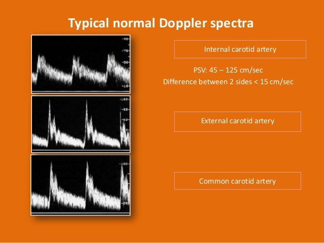 Carotid doppler ultrasound