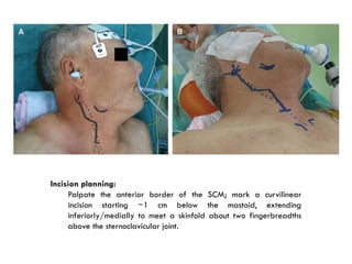 Comprehensive Overview of Carotid Endarterectomy: History, Evaluation ...