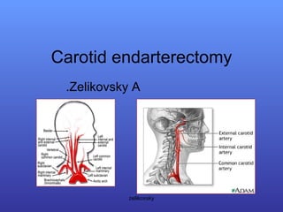 Carotid endarterectomy Zelikovsky A. zelikovsky 