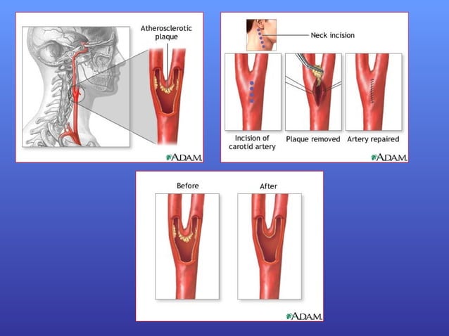 Carotid Endarterectomy | PPT