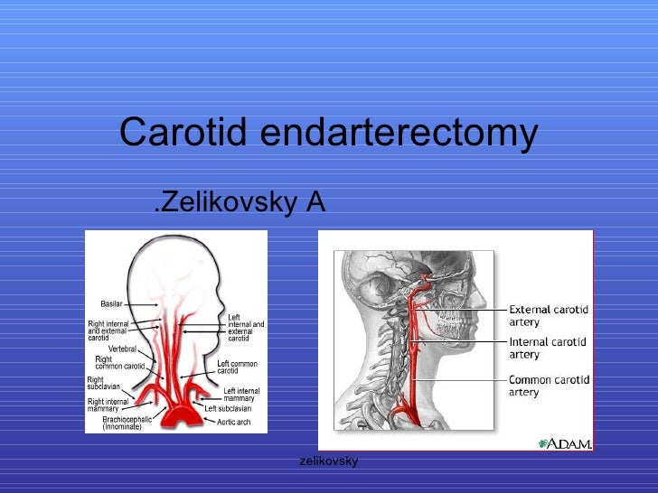 Carotid Endarterectomy Procedure Steps carotid-endarterectomy-procedure-steps