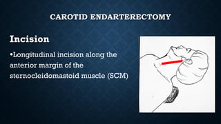 Optimising care for carotid stenosis from screening to surgery | PPT