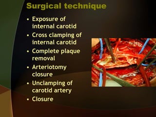 Anesthesia for Carotid Surgery | PPT