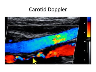 Carotid Doppler
 