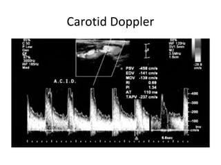 Carotid Doppler
 