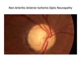 Non-Arteritic Anterior Ischemic Optic Neuropathy
 