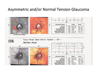 Asymmetric and/or Normal Tension Glaucoma
 
