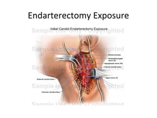 Endarterectomy Exposure
 