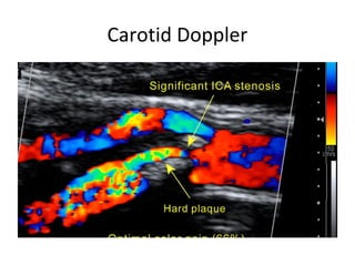 Carotid Doppler
 
