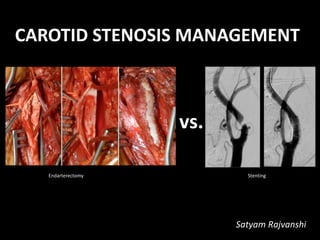 CAROTID STENOSIS MANAGEMENT
Satyam Rajvanshi
Endarterectomy Stenting
vs.
 