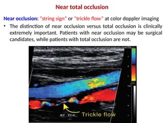 Carotid Ultrasound for examination of carotid and vertebral artries | PPTX