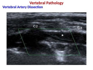 Carotid Ultrasound for examination of carotid and vertebral artries | PPTX