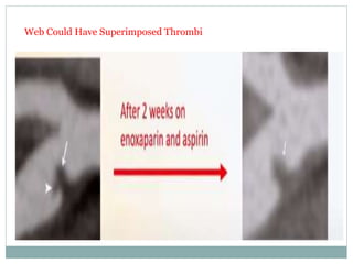 Web Could Have Superimposed Thrombi
 