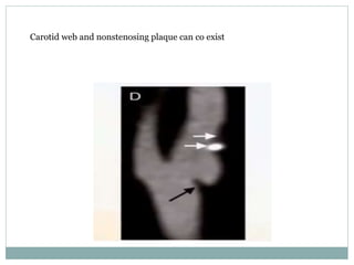 Carotid web and nonstenosing plaque can co exist
 