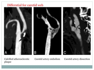 Differntial for carotid web
Calcified atherosclerotic
plaque
Carotid artery embolism Carotid artery dissection
 