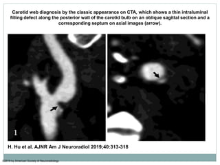 Carotid web diagnosis by the classic appearance on CTA, which shows a thin intraluminal
filling defect along the posterior wall of the carotid bulb on an oblique sagittal section and a
corresponding septum on axial images (arrow).
H. Hu et al. AJNR Am J Neuroradiol 2019;40:313-318
©2019 by American Society of Neuroradiology
 