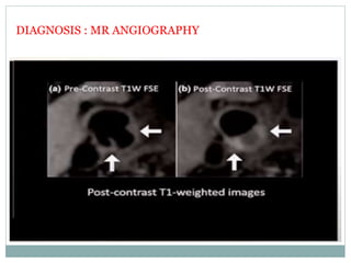 DIAGNOSIS : MR ANGIOGRAPHY
 