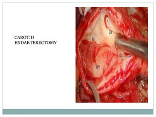 CAROTID
ENDARTERECTOMY
 