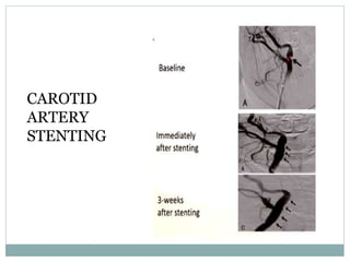 CAROTID
ARTERY
STENTING
 