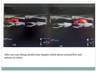 After one year doing carotid color doppler which shows normal flow and
patency in artery.
 
