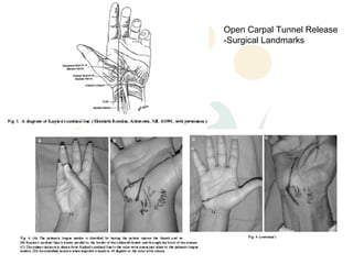 Open Carpal Tunnel Release
-Surgical Landmarks
 