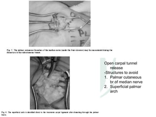 Open carpal tunnel
    release
-Structures to avoid
1. Palmar cutaneous
    br of median nerve
2. Superficial palmar
    arch
 