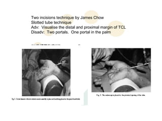 Two incisions technique by James Chow
Slotted tube technique
Adv: Visualise the distal and proximal margin of TCL
Disadv: Two portals. One portal in the palm
 