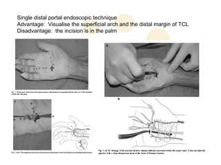 Single distal portal endoscopic technique
Advantage: Visualise the superficial arch and the distal margin of TCL
Disadvantage: the incision is in the palm
 