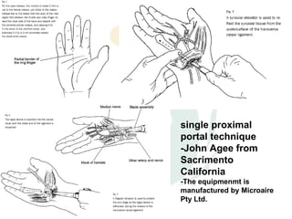 single proximal
portal technique
-John Agee from
Sacrimento
California
-The equipmenmt is
manufactured by Microaire
Pty Ltd.
 