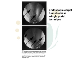 Endoscopic carpal
tunnel release
-single portal
technique
 