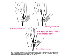 Sub-ligamentous
Extra-ligamentous
                     The recurrent motor branch
                     of the median nerve




                    Trans-ligamentous
 