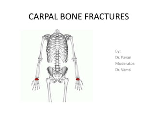 CARPAL BONE FRACTURES
By:
Dr. Pavan
Moderator:
Dr. Vamsi
 