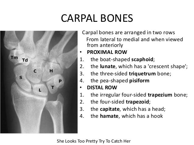 Carpal bone fractures