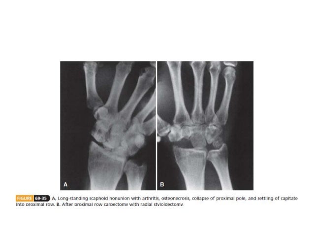 Carpal bone fractures