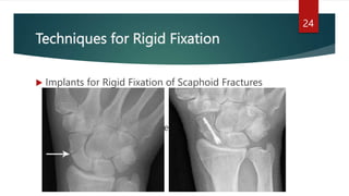 Semi Rigid Fixation Examples Carpal Bones Fractures.pptx