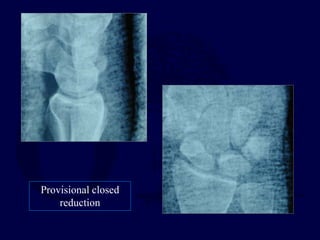 Provisional closed
reduction
 