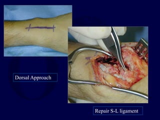 Dorsal Approach
Repair S-L ligament
 