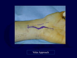 Volar Approach
 