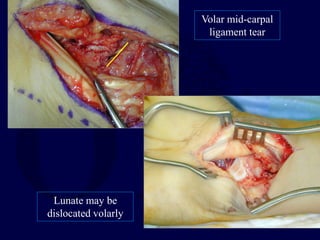 Lunate may be
dislocated volarly
Volar mid-carpal
ligament tear
 