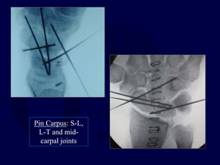 Pin Carpus: S-L,
L-T and mid-
carpal joints
 