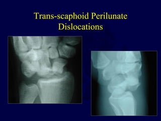Trans-scaphoid Perilunate
Dislocations
 