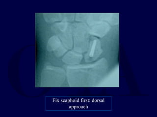 Fix scaphoid first: dorsal
approach
 