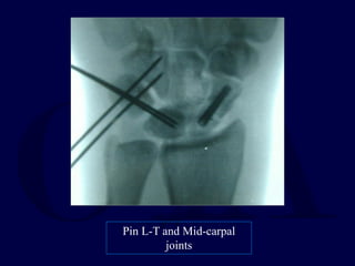 Pin L-T and Mid-carpal
joints
 