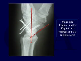 Make sure
Radius-Lunate-
Capitate are
colinear and S-L
angle restored
 