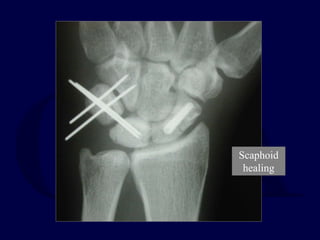 Scaphoid
healing
 